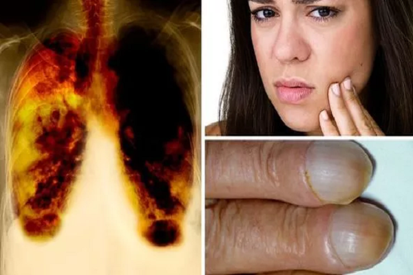 Ung thư phổi - Những triệu chứng có thể phát hiện qua móng tay