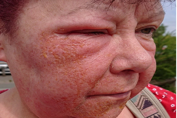 Người phụ nữ bị phổng rộp da và khó thở sau khi dùng kem tẩy lông Veet
