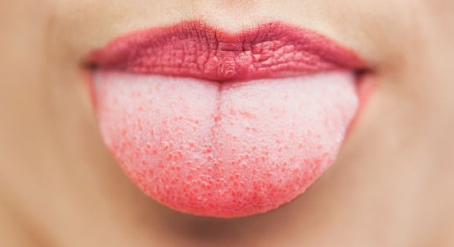 Ung thư lưỡi tăng cao do lầm tưởng nhiệt miệng