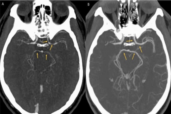  Ảnh chụp CT cho thấy những mạch máu chính trong não người đàn ông 34 tuổi bị co lại bất thường. Ảnh: ScienceNews