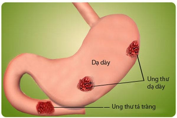 Ung thư dạ dày có thể ảnh hưởng đến hệ tiêu hóa gây táo bón, tiêu chảy