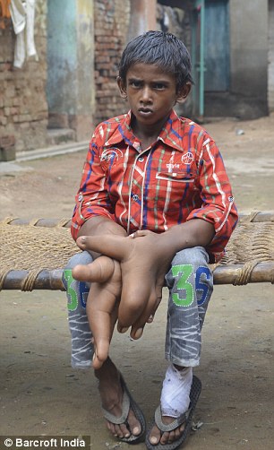 Cậu bé Ấn Độ tên là Kaleem không thể thực hiện bất được những việc đơn giản bằng đôi tay của mình, kể cả buộc dây giày.