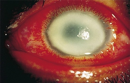 Một số nghiên cứu chỉ ra, chỉ trong chưa đầy một ngày đeo kính, loại amip này đã gặm nhấm 70 dây thần kinh thị giác. Hậu quả của việc tấn công của Acanthamoeba là triệu chứng mắt ngứa rát, chảy nước mắt sống, mắt nhìn mờ, nhạy cảm ánh sáng, sưng phồng mí, đau mắt. Nguy hiểm hơn, Acanthamoeba sẽ ăn mòn nhãn cầu khiến người bệnh bị mất thị lực vĩnh viễn.