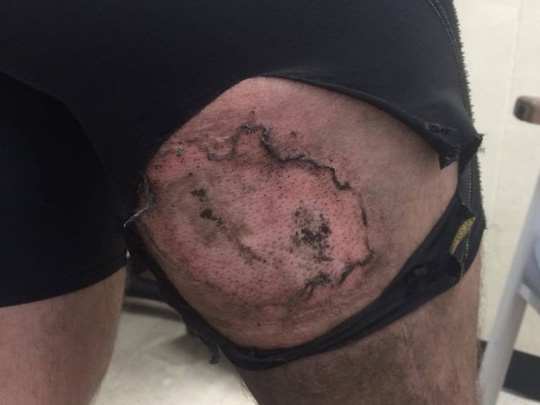 Vết bỏng trên đùi của Gareth Clear do chiếc iPhone 6 phát nổ trong túi quần