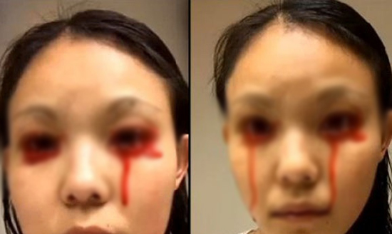 Căn bệnh chảy máu mắt kỳ lạ. Ảnh minh hoạ