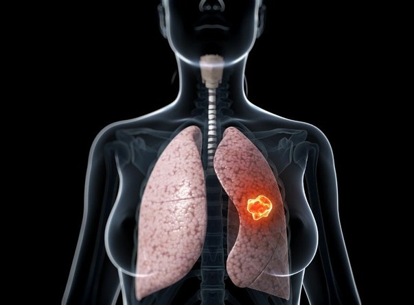 Nấc liên tục kèm ho kéo dài, ho ra máu, tức ngực là những biểu hiện của bệnh ung thư phổi