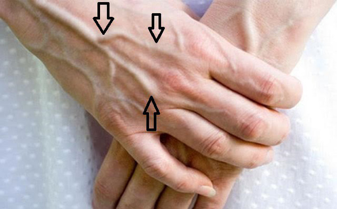 Nổi gân xanh: Đừng coi thường bởi đó có thể là căn bệnh nguy hiểm chết người này Nổi gân xanh: Đừng coi thường bởi đó có thể là căn bệnh nguy hiểm chết người này