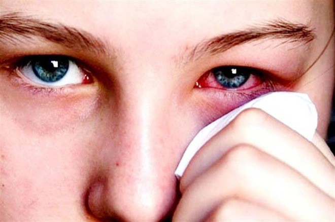 Bệnh đau mắt đỏ bắt đầu hoành hành: Làm thế nào để phòng tránh?