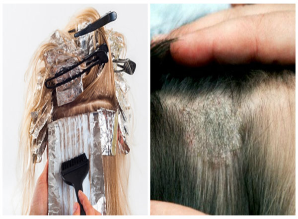 Thuốc nhuộm tóc có thể làm bong tróc da đầu, dị ứng 