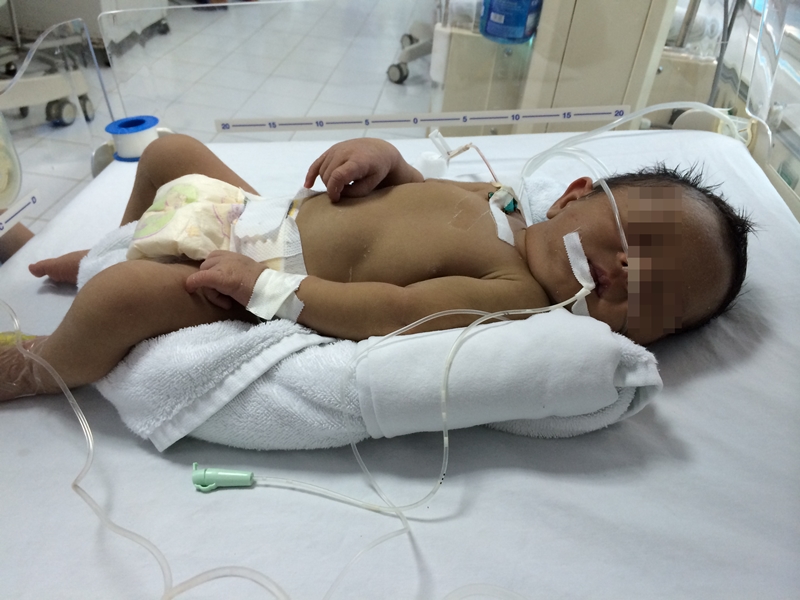 Ngộ độc sái thuốc phiện, trẻ sơ sinh 20 ngày tuổi vào viện cấp cứu