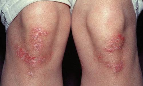 Bệnh vảy nến  là bệnh về da thường gặp vào mùa đông