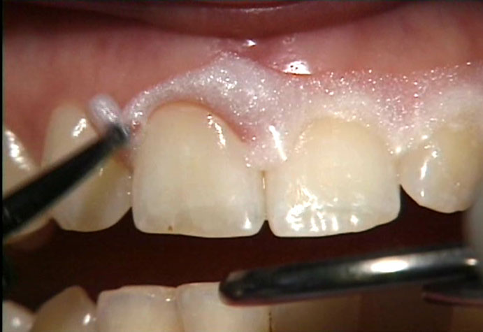 Thuốc tẩy trắng răng không đúng cách có thể gây tổn thương nướu.