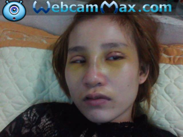Mắt chị Việt Hà sau gần 1 tháng bấm mí vẫn chưa lành Mắt chị Việt Hà sau gần 1 tháng bấm mí vẫn chưa lành