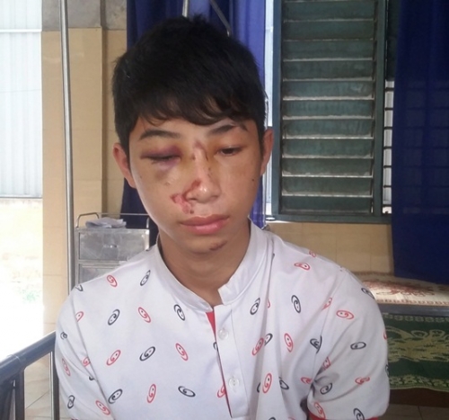 Em Nguyễn Đức Phú cho biết đã bị Trưởng công an xã Hương Hóa đánh đến mức nhập viện vì nhầm em là kẻ trộm