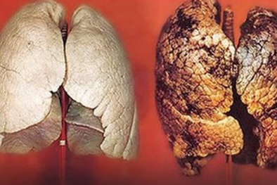 Cảnh báo những nguyên nhân gây nên ung thư phổi quái ác