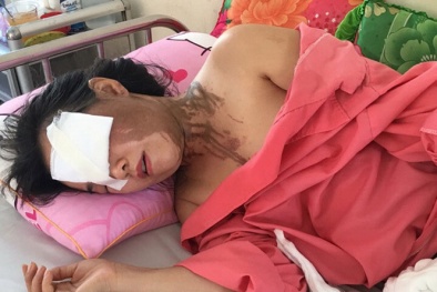 Tạt axit người khác: Tội ác tàn độc mà không phải giết người