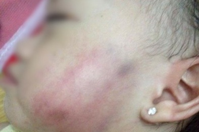 Bé gái 16 tháng tuổi bị bầm tím mặt: Đình chỉ hoạt động Ánh Sao, công an vào cuộc