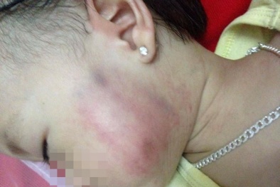 Gia đình tố bé gái 1 tuổi bị tát bầm mặt, cô giáo khăng khăng nói trẻ bị ngã