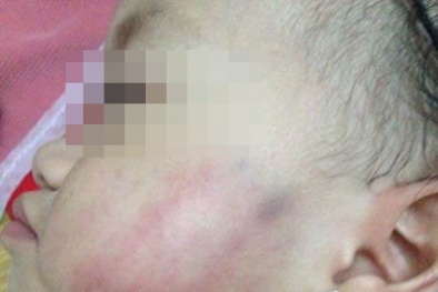 Nghi án bé 16 tháng tuổi bị đánh thâm tím mặt: Đuổi việc cô giáo Bùi Thị Lương