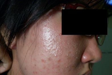 Da mặt hóa da cóc vì dùng kem trắng da ‘siêu tốc’