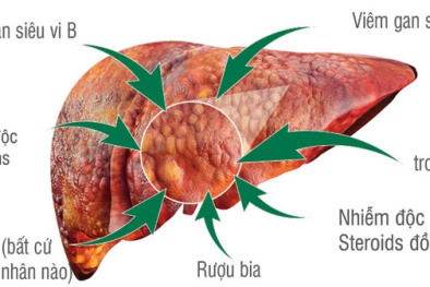 Bí quyết phòng tránh ung thư gan dành cho người hay uống rượu