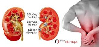 Coi chừng sỏi thận từ những thói quen tưởng bình thường
