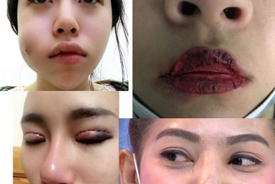 Mất xinh vì… dịch vụ thẩm mỹ cắt mí, phun môi ‘vườn’