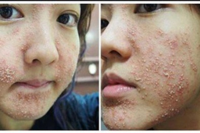 Nguy cơ mặt hóa 'ác quỷ' vì lạm dụng mỹ phẩm trôi nổi