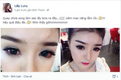 Loét giác mạc vì kính áp tròng