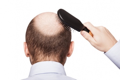 Quá nguy hiểm khi sử dụng thuốc chữa hói đầu