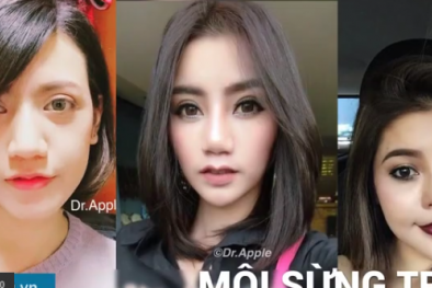 Thẩm mỹ 'môi sừng trâu' những biến chứng kinh hoàng