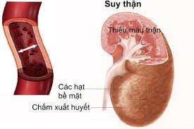 'Thực phẩm vàng' hỗ trợ điều trị suy thận do tiểu đường gây nên