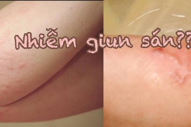 Ngứa da nổi mề đay là do nhiễm giun sán?