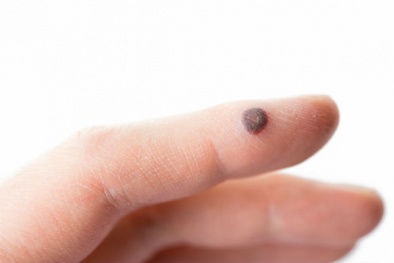 Cách đơn giản và an toàn nhất để loại bỏ mụn cóc tại nhà