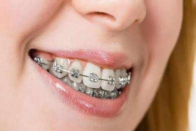 Niềng răng không đúng cách có thể bị 'bay' cả hàm