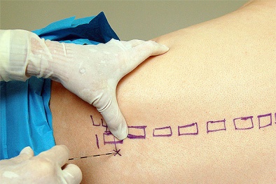 Cấm gây tê tủy sống sản phụ sinh mổ: Thứ trưởng Bộ Y tế làm rõ thông tin