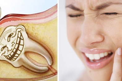 Nhổ răng khôn: Cảnh giác với những biến chứng có thể gây tử vong