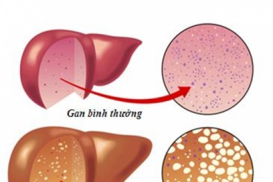 Báo động: Cứ 4 người có 1 người mắc bệnh này, ai đang cần cảnh giác nhất