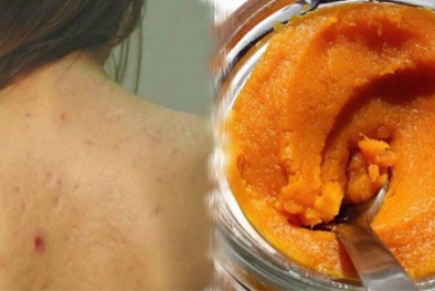 Lý do khiến nổi mụn ở lưng triền miên và tuyệt chiêu rẻ tiền dứt điểm mụn