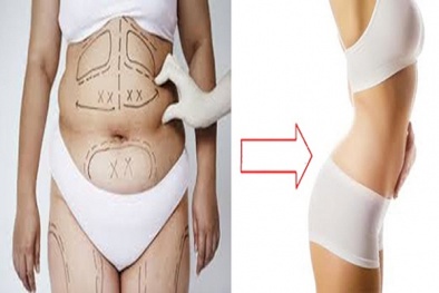 Hút mỡ bụng và những biến chứng, di chứng khôn lường