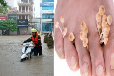 Mùa mưa và những nguy cơ khiến đôi bàn chân thành ‘tật’