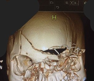Hình ảnh chụp sọ này sẽ làm bạn nhất định phải cài dây an toàn khi đi xe