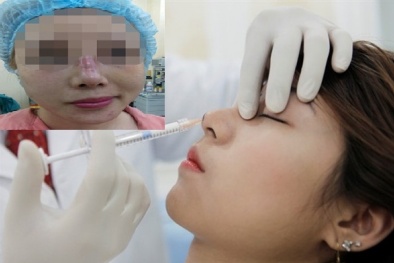 Hoại tử phần thịt ở mũi vì cấy chỉ nâng mũi không đảm bảo