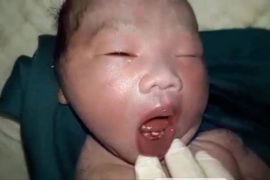 Giải mã bí ẩn bé trai vừa sinh đã mọc răng cửa