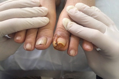 Người bị bệnh tiểu đường ngâm chân vào nước muối coi chừng mất chân