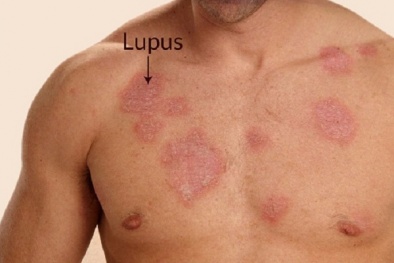 Mắc bệnh Lupus ban đỏ mà sử dụng thuốc liều lĩnh nguy cơ tử vong