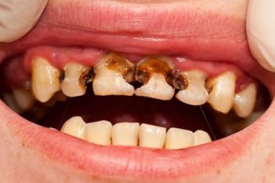 Con người sắp không còn sợ... sâu răng?