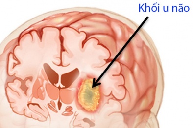 Nhức đầu là một trong 8 dấu hiệu cảnh báo ung thư não