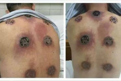 Giác hơi có thể gây sốc nhiệt, tử vong nếu làm sai cách