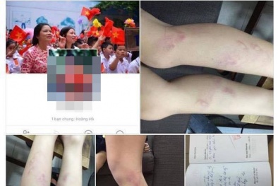 Cô giáo đánh học sinh lớp 2 tím chân chỉ vì vào lớp muộn